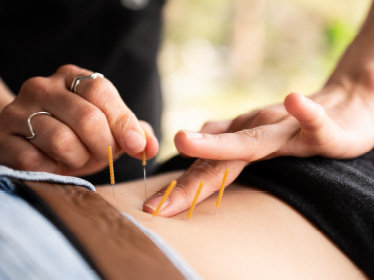 Dry Needling